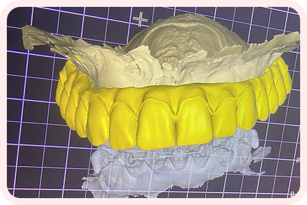 implante-dentário-em-águas-claras-om-tecnologia1