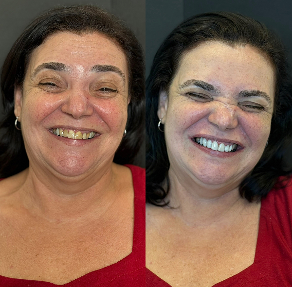 antes-e-depois-lentes-dentais-aguas-claras-brasilia10
