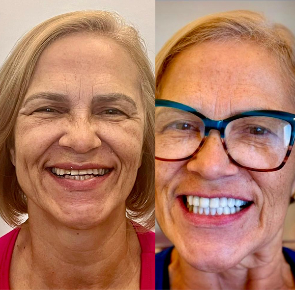 antes-e-depois-lentes-dentais-aguas-claras-brasilia11