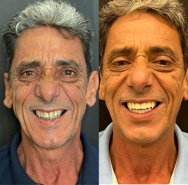 antes-e-depois-lentes-dentais-aguas-claras-brasilia12