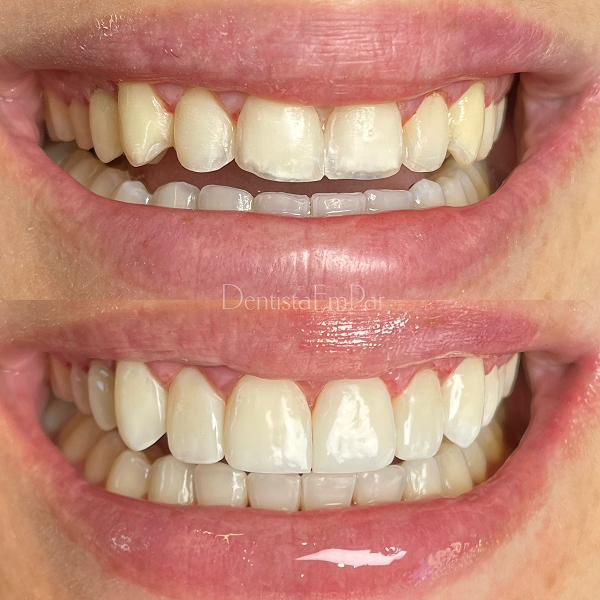 antes-e-depois-lentes-dentais-aguas-claras-brasilia14