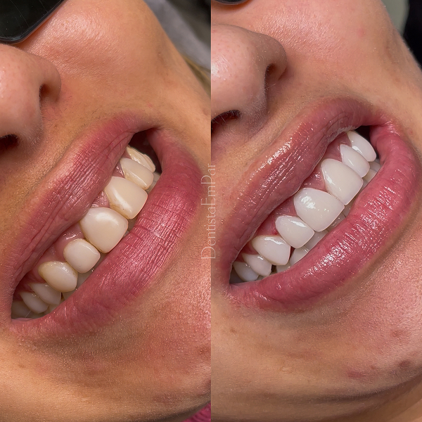 antes-e-depois-lentes-dentais-aguas-claras-brasilia15