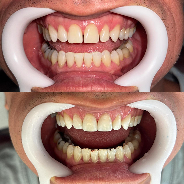 antes-e-depois-lentes-dentais-aguas-claras-brasilia16