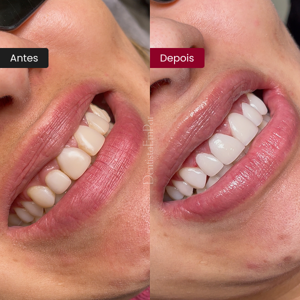 lentes-de-contato-dentais-em-resina-e-porcelana-aguas-claras-brasilia2